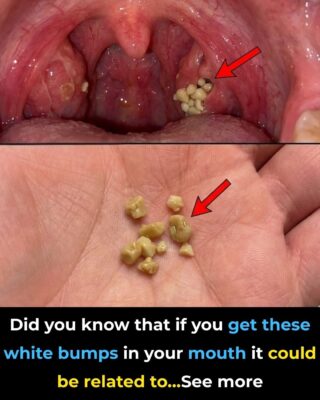 Tonsil Stones: Discover what they are, how they appear, and how to get rid of them forever.